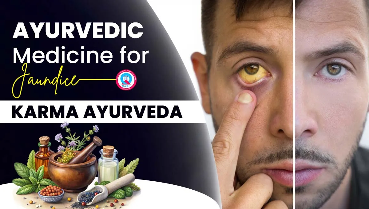 ayurvedic-medicine-for-jaundice